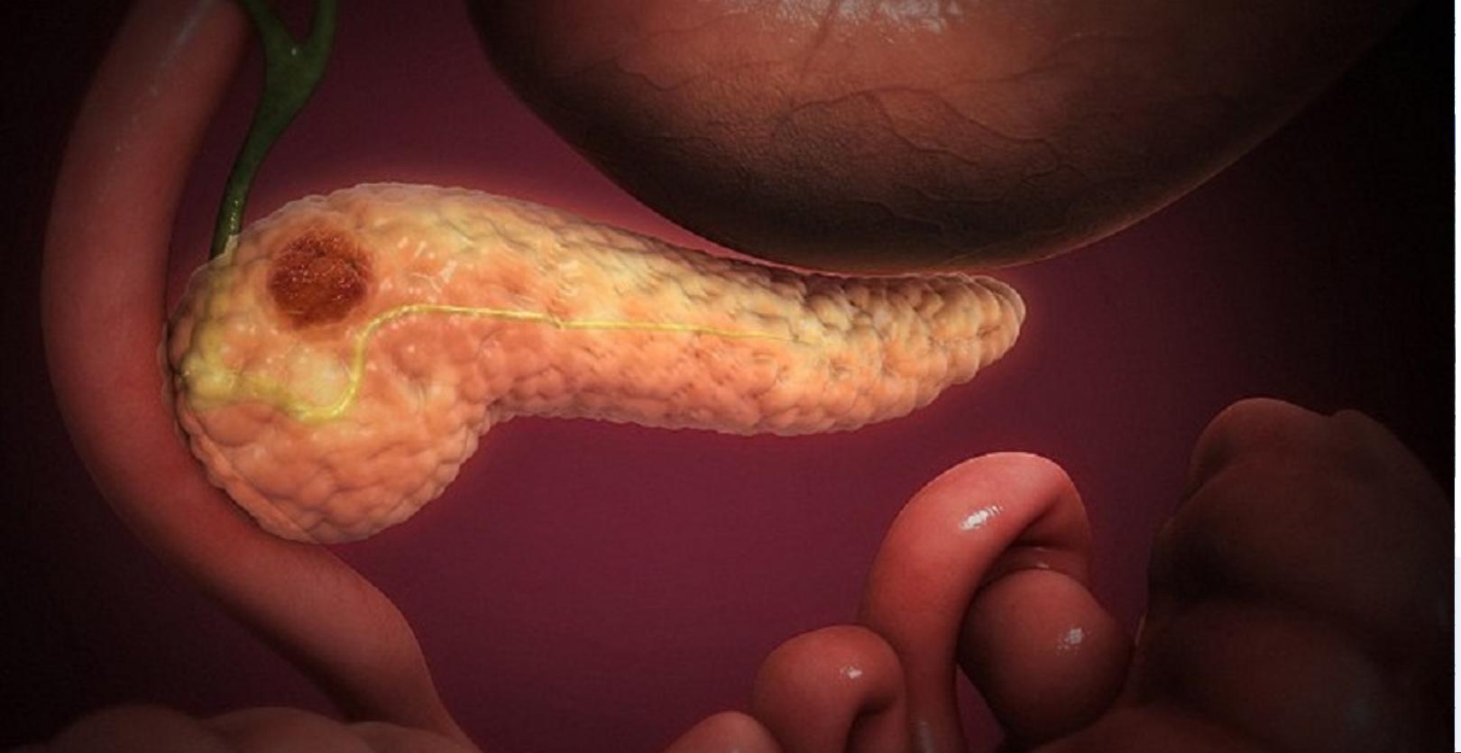 Identifican un nuevo biomarcador para el diagnóstico precoz del cáncer de páncreas